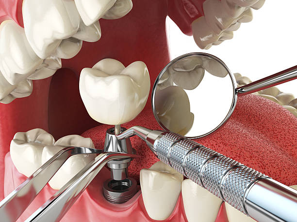 Best Emergency Wisdom Teeth Removal in Bath, MI