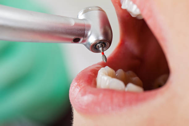 Best Emergency Root Canal Treatment in Bath, MI